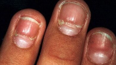 Plicatured Nail