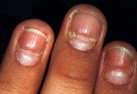 Plicatured Nail